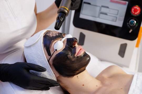 Carbon Laser Facial